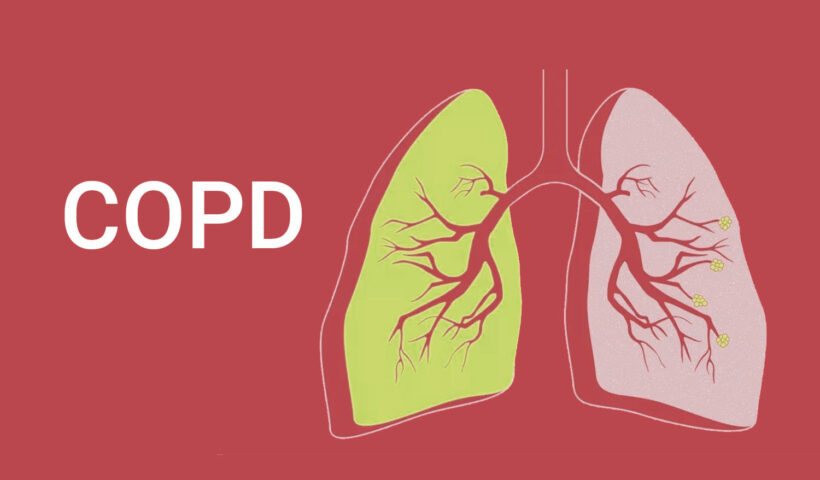 COPD Symptoms and Prevention
