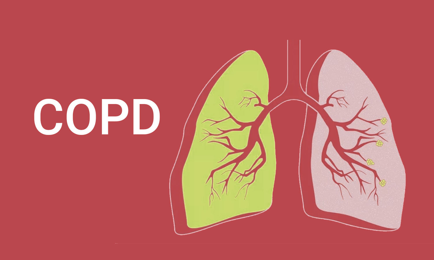 COPD Symptoms and Prevention